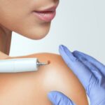 Warts and Wart Removal