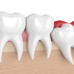 Wisdom Tooth in Liverpool