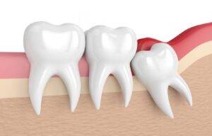 Wisdom Tooth in Liverpool