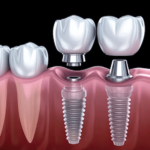 Dental implants  