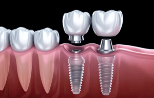 Dental implants  