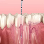 modern root canal treatment