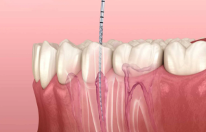 modern root canal treatment