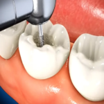most profound change in root canal treatment is experiential.