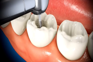 most profound change in root canal treatment is experiential.