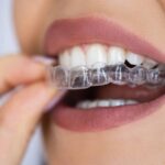 modern solutions like Invisalign use to improve smiles