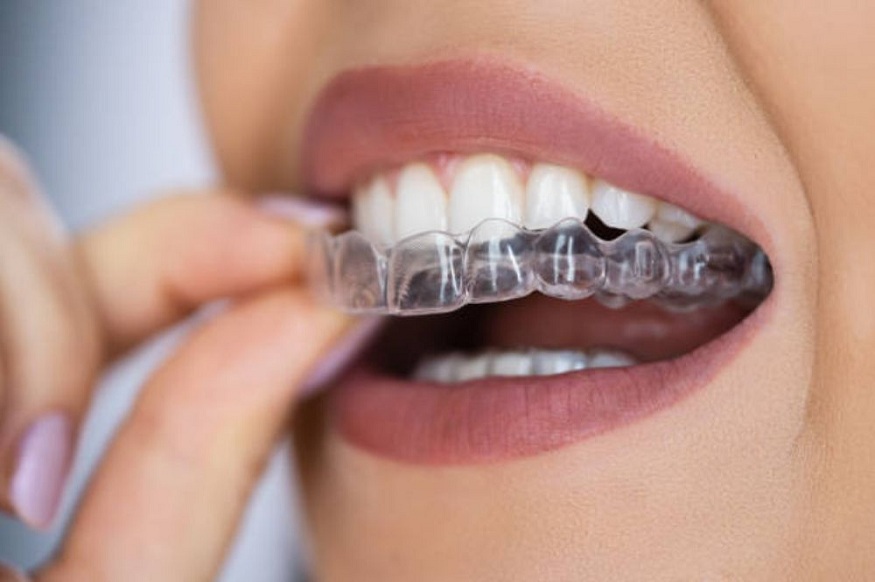 modern solutions like Invisalign use to improve smiles