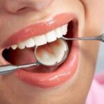 Dental Fillings Last