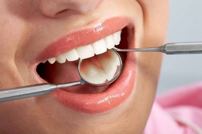 Dental Fillings Last