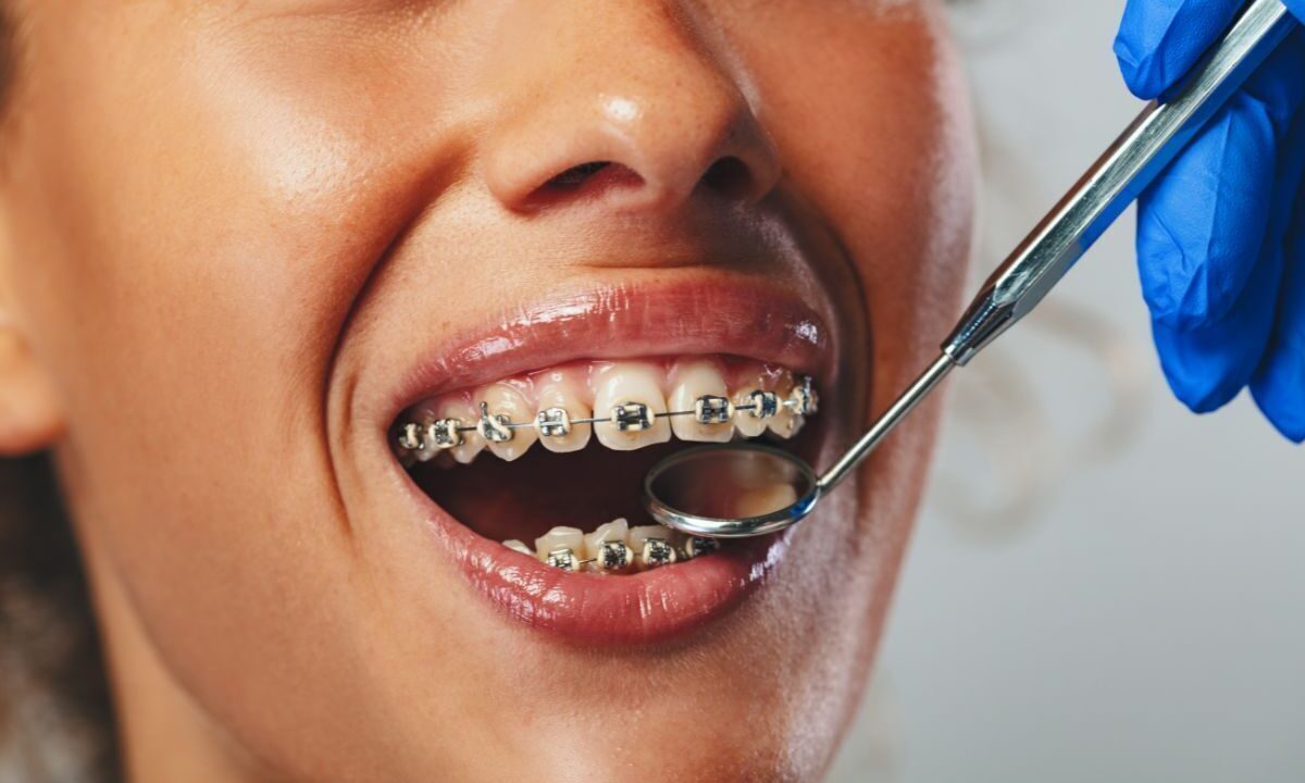 Oral Care a Natural Part of Orthodontic Treatment